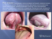 Информационные материалы по раннней диагностике новообразований полости рта и глотки