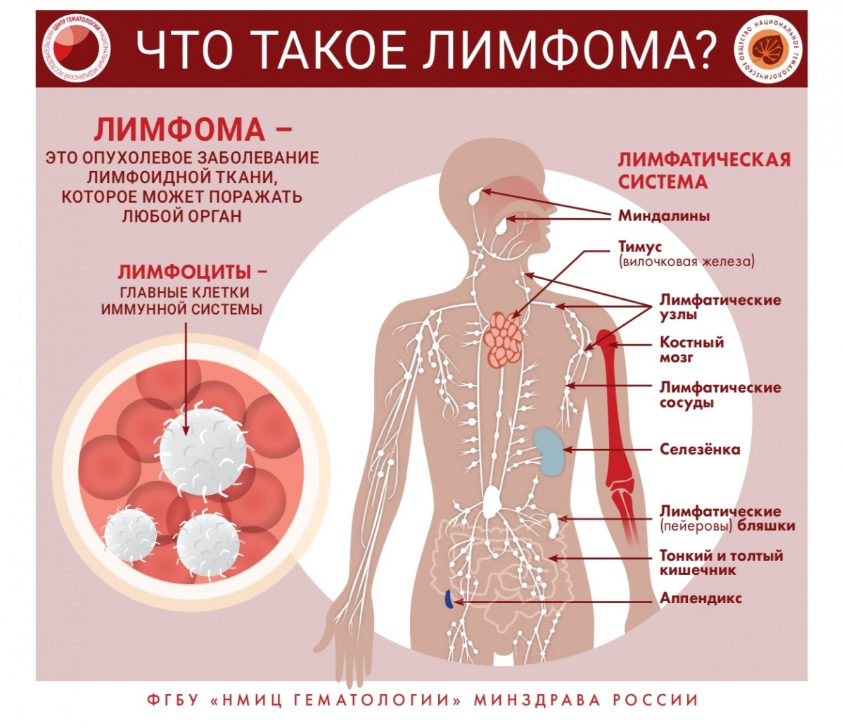 Признаки и симптомы неходжкинской лимфомы,