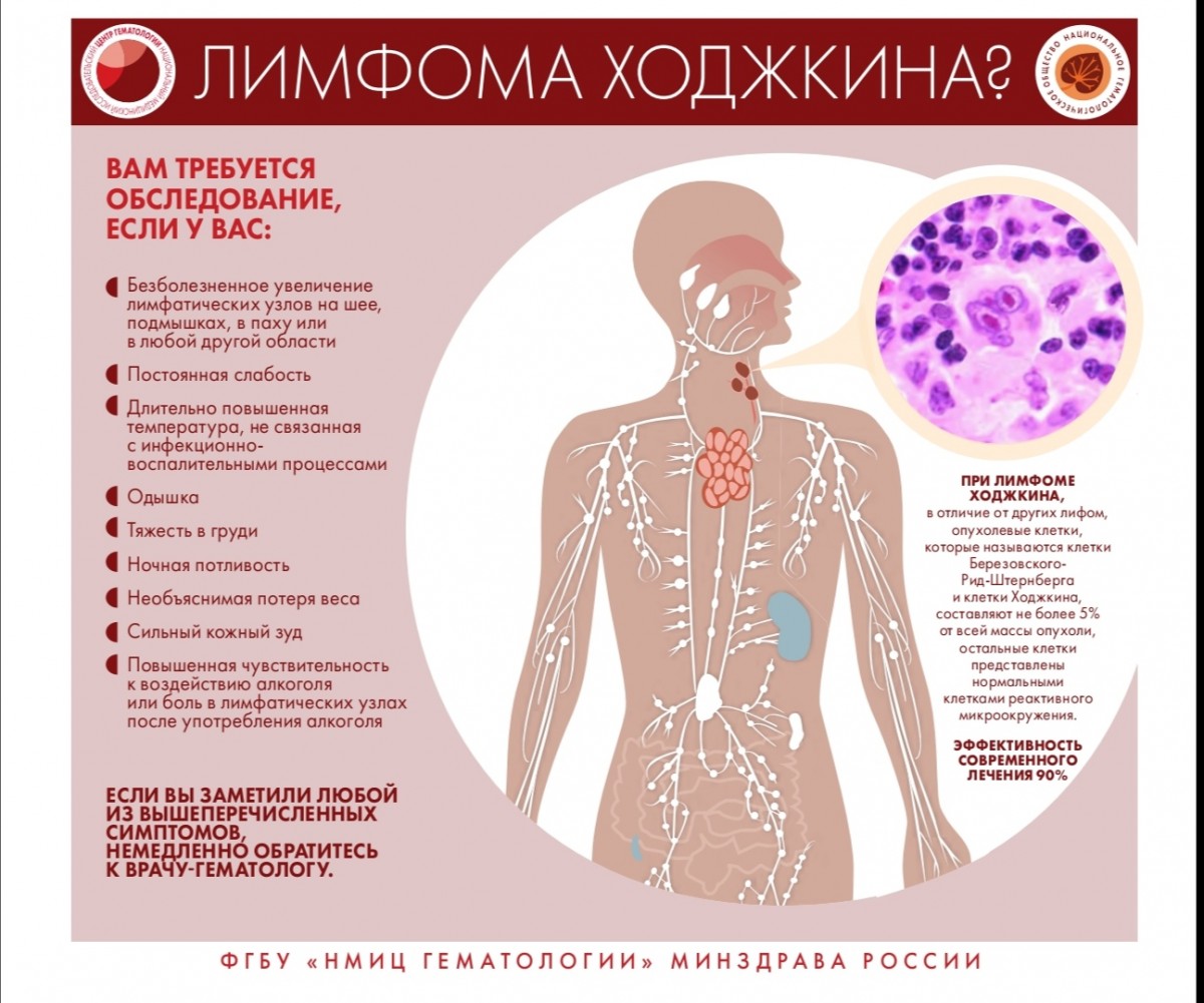 Признаки и симптомы неходжкинской лимфомы,